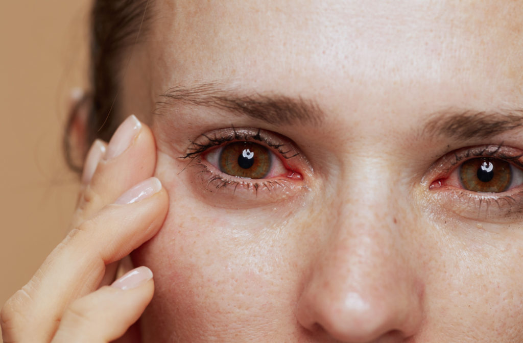 A close-up of a woman's inflamed eyes sue to allergic reaction.