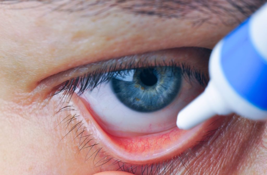 A close up of a man's blue eye being stretched to create a pocket for a bottle of eye ointment.