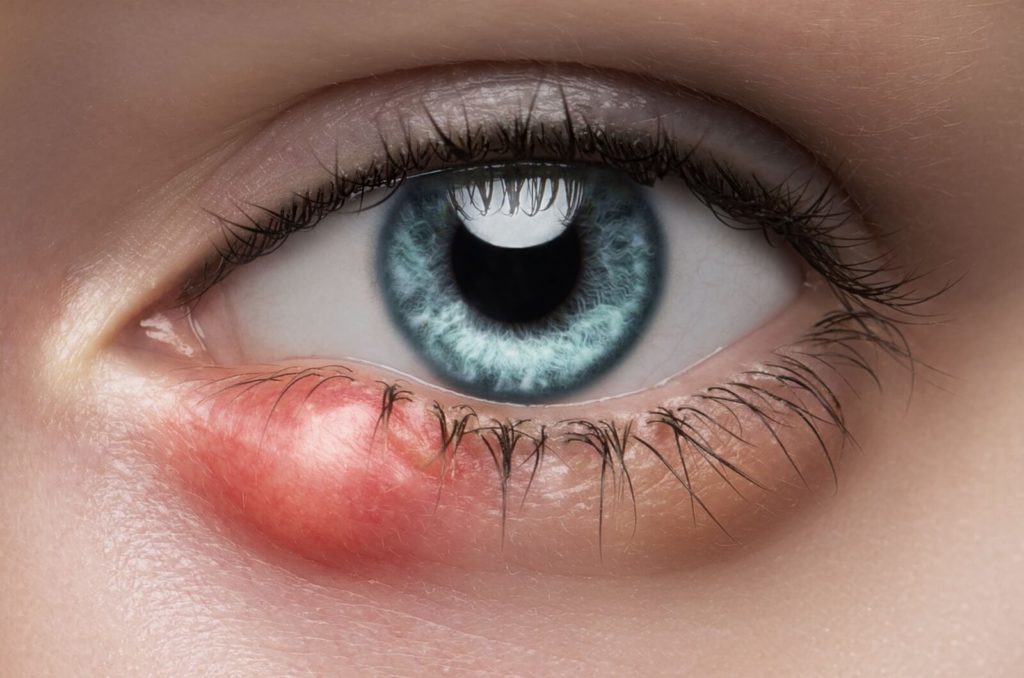 A close-up image of a woman's eye with a swollen hardened chalazion on her lower eyelid.