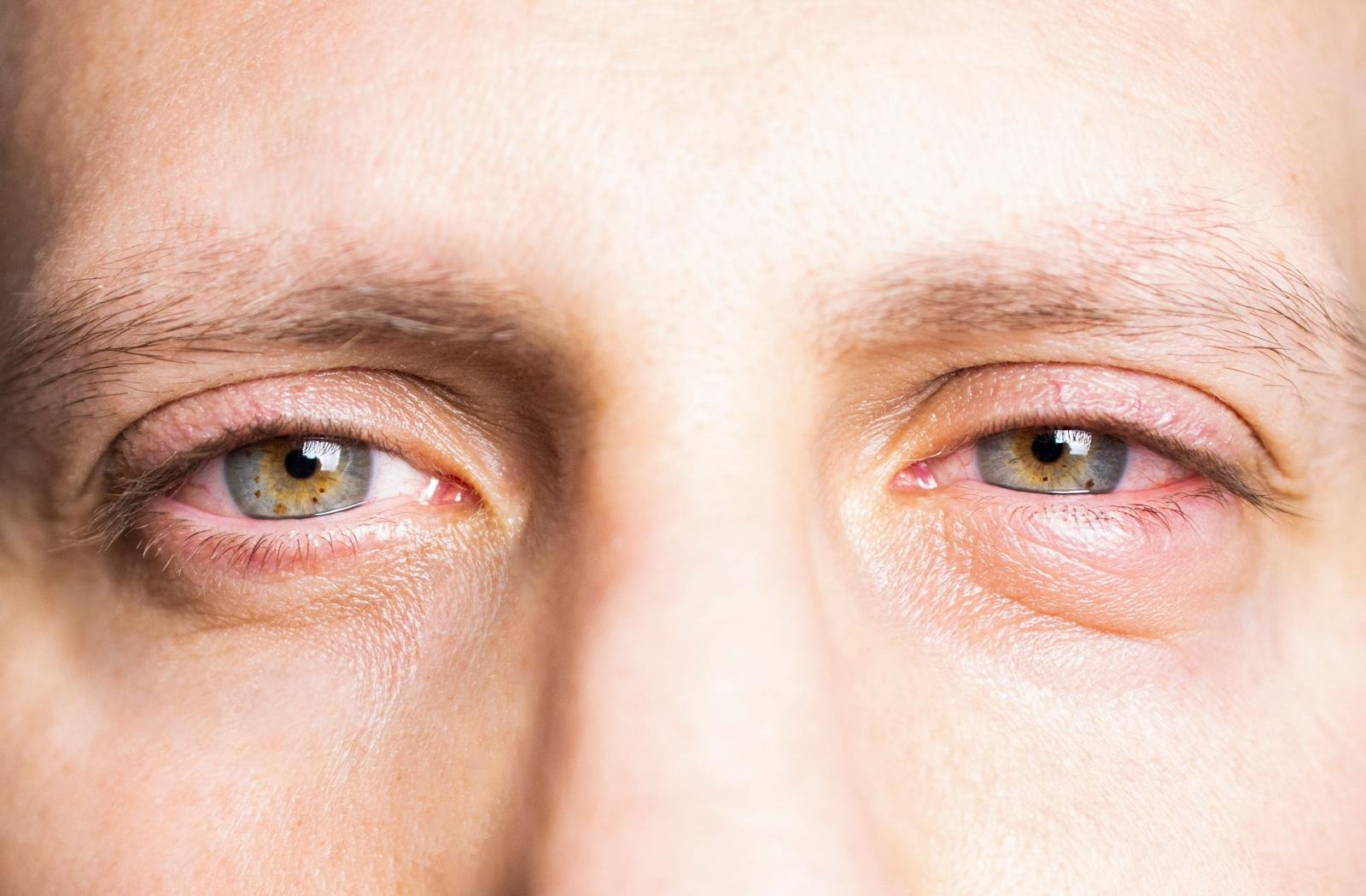 A close up of swollen eyes due to allergies.